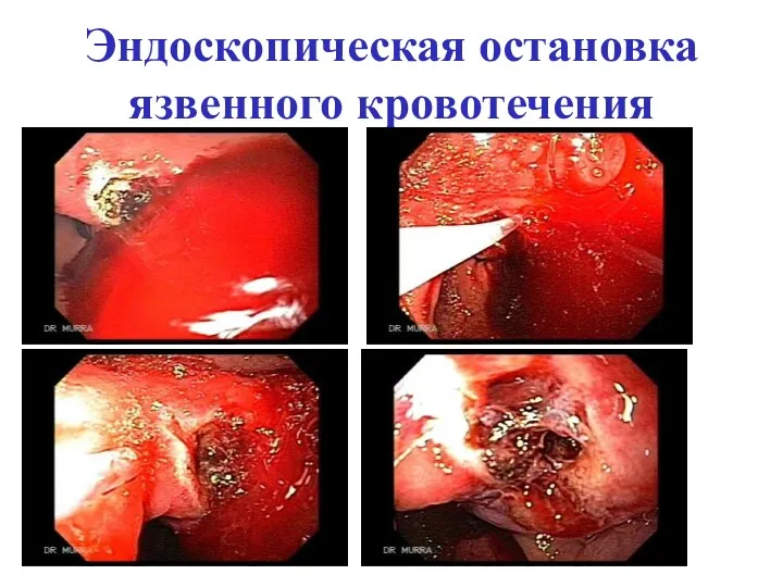 Эндоскопическая остановка язвенного кровотечения