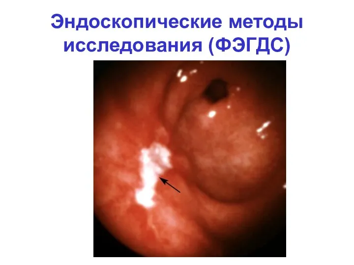 Эндоскопические методы исследования (ФЭГДС)