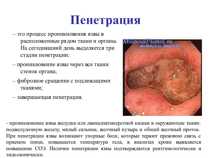 Пенетрация – это процесс проникновения язвы в расположенные рядом ткани