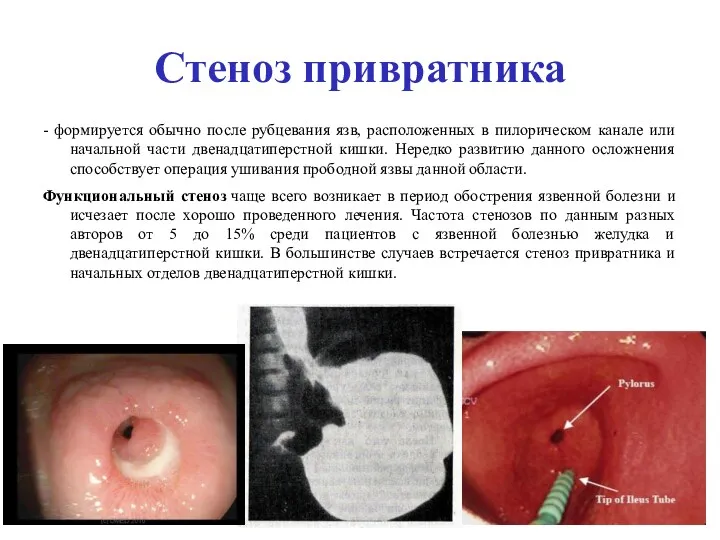 Стеноз привратника - формируется обычно после рубцевания язв, расположенных в