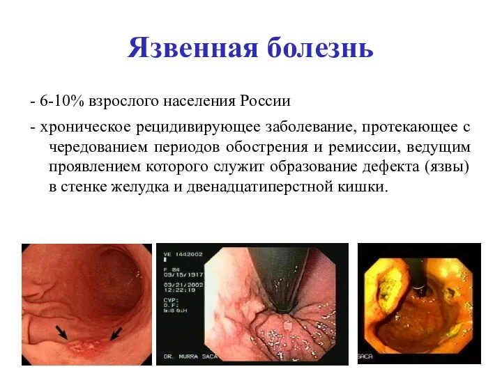 Язвенная болезнь - 6-10% взрослого населения России - хроническое рецидивирующее