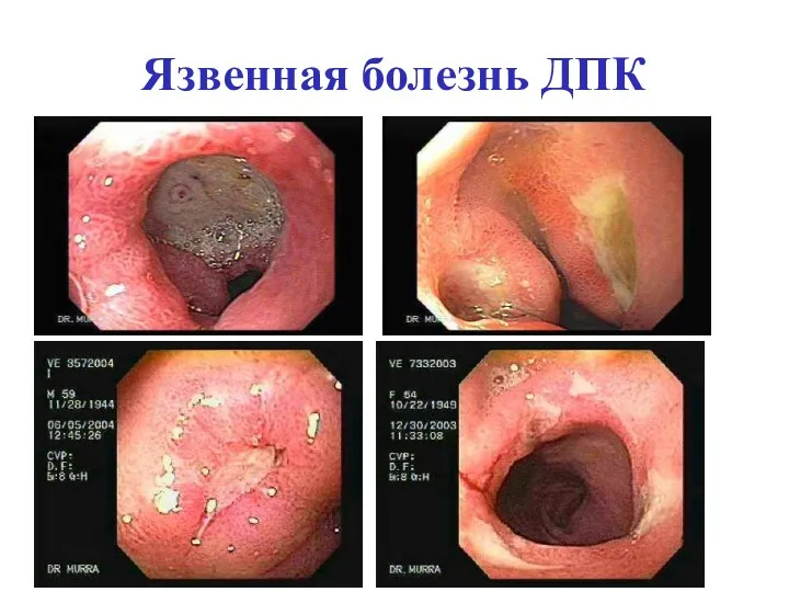 Язвенная болезнь ДПК