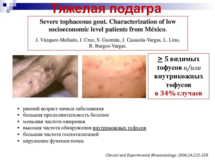 Тяжелая подагра Clinical and Experimental Rheumatology. 2006:24;233-238 ранний возраст начала