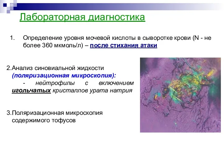 Лабораторная диагностика Анализ синовиальной жидкости (поляризационная микроскопия): - нейтрофилы с