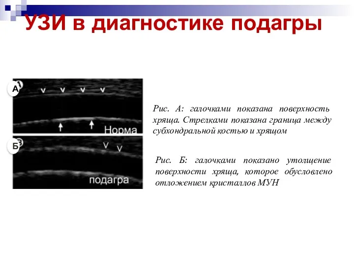 УЗИ в диагностике подагры Рис. А: галочками показана поверхность хряща.