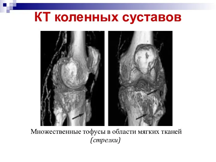 КТ коленных суставов Множественные тофусы в области мягких тканей (стрелки)