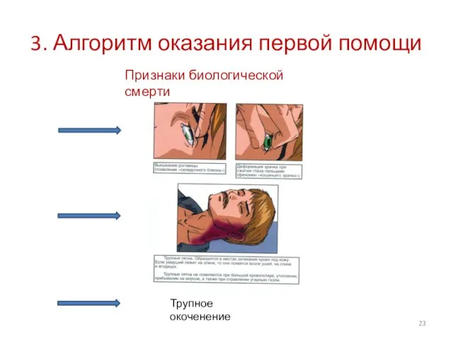 3. Алгоритм оказания первой помощи Признаки биологической смерти Трупное окоченение