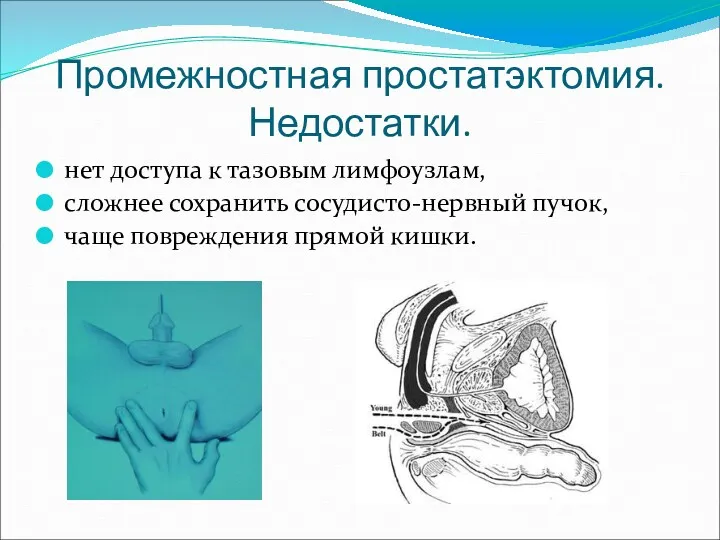 Промежностная простатэктомия. Недостатки. нет доступа к тазовым лимфоузлам, сложнее сохранить сосудисто-нервный пучок, чаще повреждения прямой кишки.