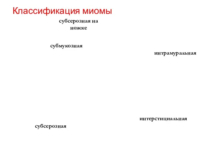 Классификация миомы субмукозная субсерозная на ножке интрамуральная интерстициальная субсерозная