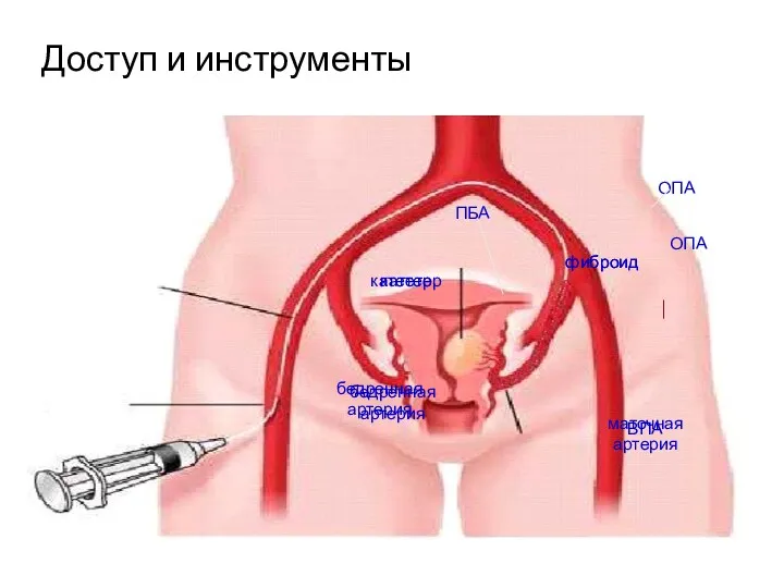 Доступ и инструменты катетер бедренная артерия фиброид маточная артерия ПБА