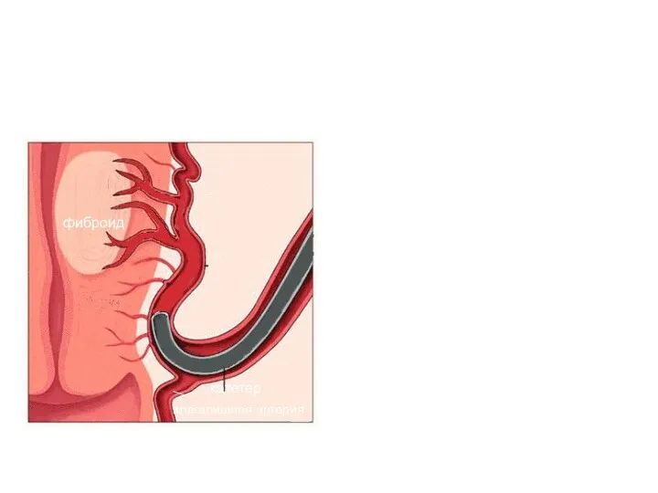 фиброид катетер влагалищная артерия