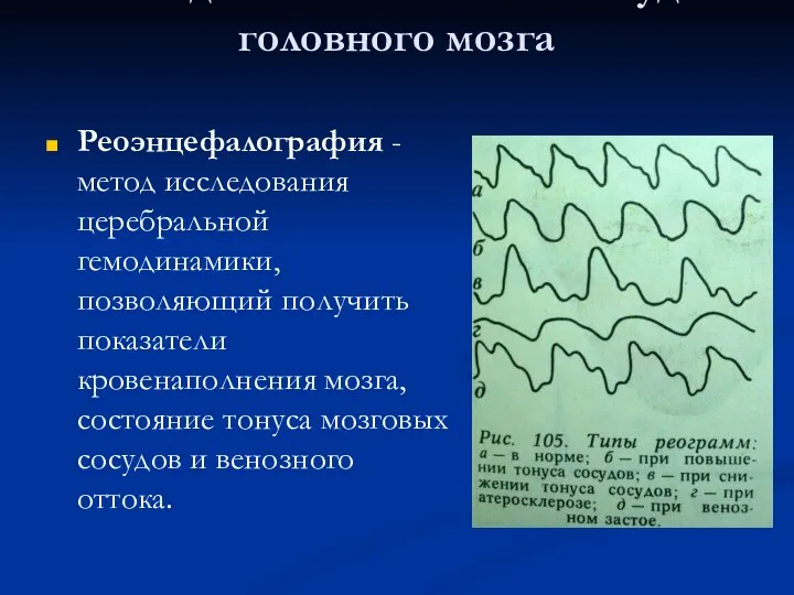 Исследование состояния сосудов головного мозга Реоэнцефалография - метод исследования церебральной