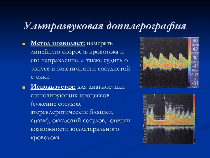 Ультразвуковая допплерография Метод позволяет: измерять линейную скорость кровотока и его