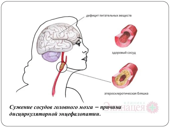 Сужение сосудов головного мозга – причина дисциркуляторной энцефалопатии.