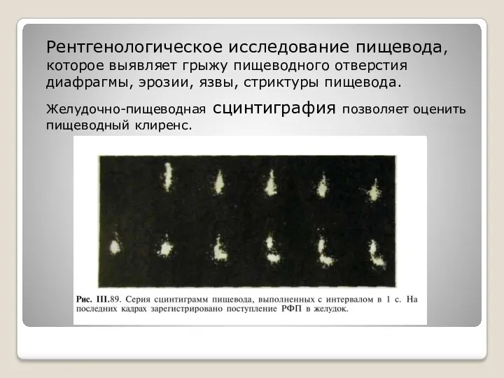 Рентгенологическое исследование пищевода, которое выявляет грыжу пищеводного отверстия диафрагмы, эрозии,