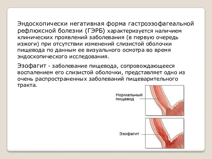 Эндоскопически негативная форма гастроэзофагеальной рефлюксной болезни (ГЭРБ) характеризуется наличием клинических