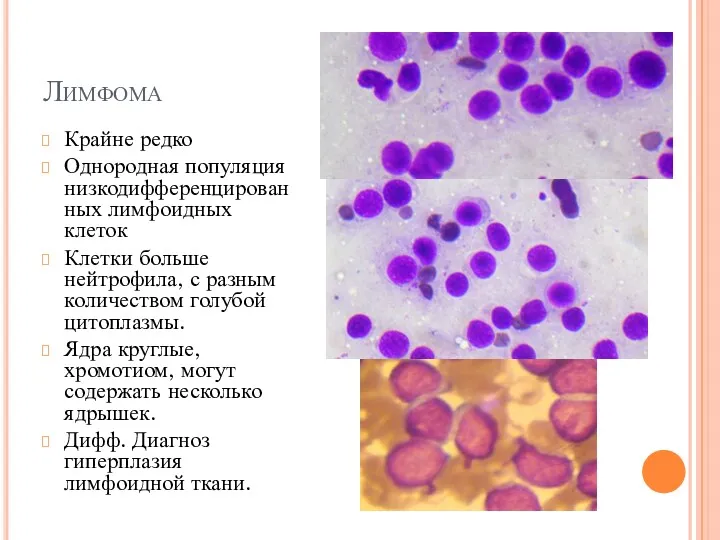 Лимфома Крайне редко Однородная популяция низкодифференцированных лимфоидных клеток Клетки больше