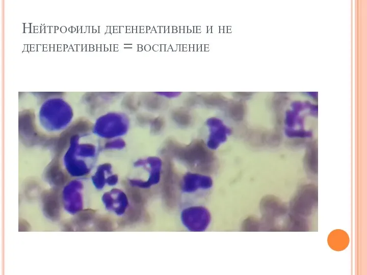 Нейтрофилы дегенеративные и не дегенеративные = воспаление