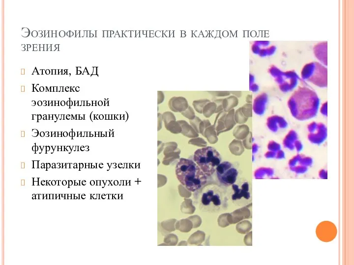 Эозинофилы практически в каждом поле зрения Атопия, БАД Комплекс эозинофильной