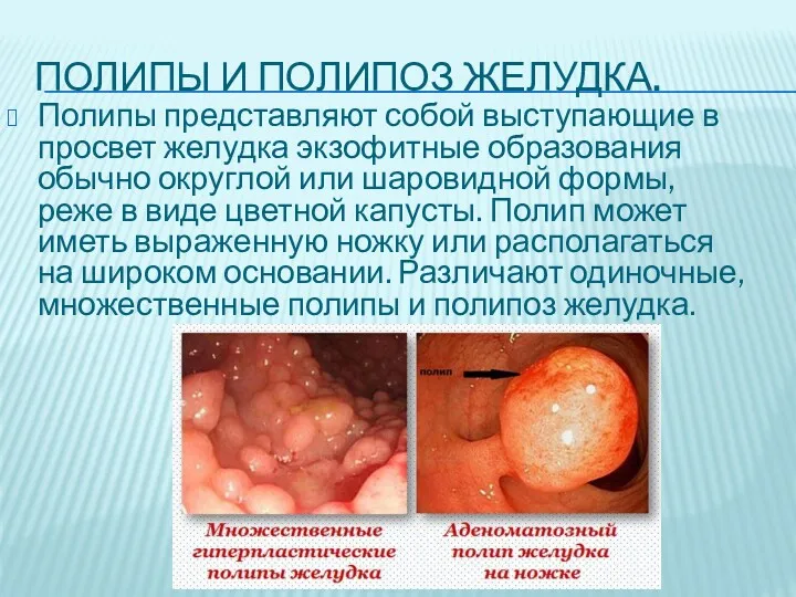 ПОЛИПЫ И ПОЛИПОЗ ЖЕЛУДКА. Полипы представляют собой выступающие в просвет