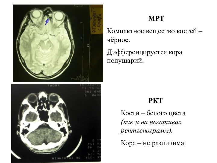 МРТ Компактное вещество костей – чёрное. Дифференцируется кора полушарий. РКТ