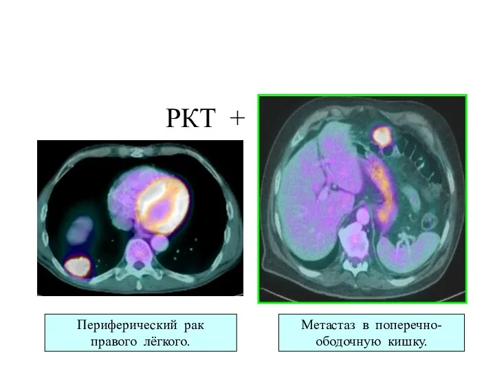РКТ + ПЭТ Метастаз в поперечно-ободочную кишку. Периферический рак правого лёгкого.