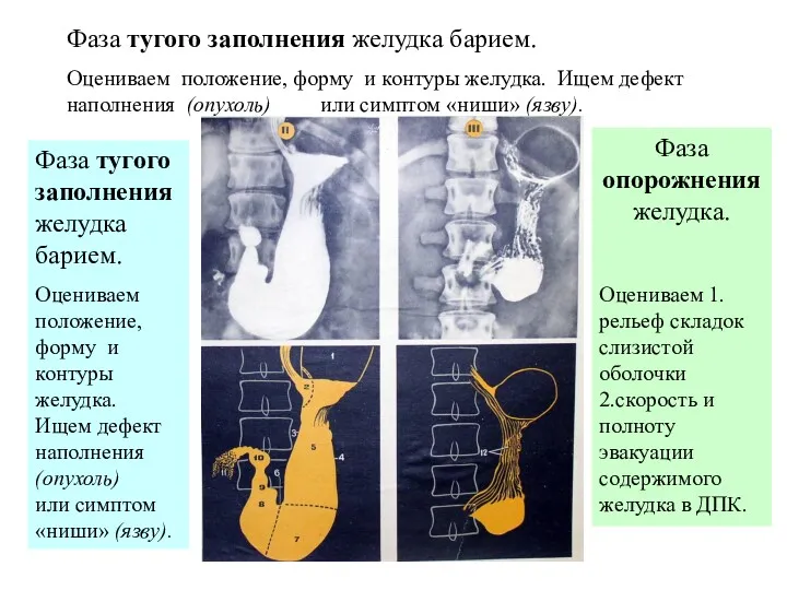 Фаза тугого заполнения желудка барием. Оцениваем положение, форму и контуры