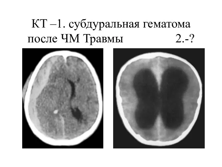 КТ –1. субдуральная гематома после ЧМ Травмы 2.-?