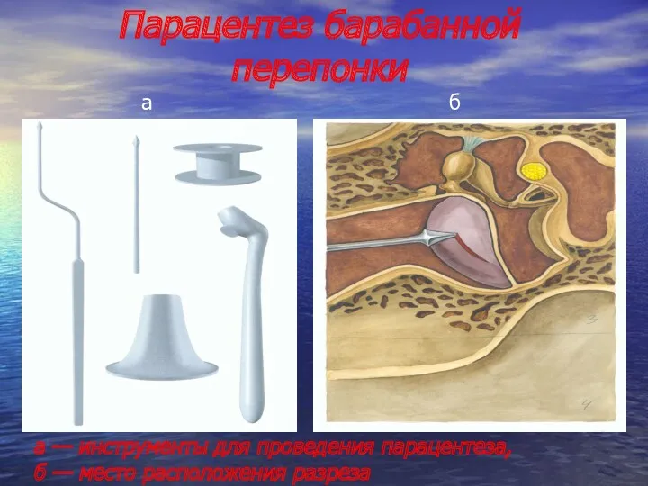 Парацентез барабанной перепонки а б а — инструменты для проведения парацентеза, б — место расположения разреза