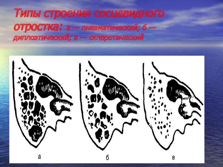 Типы строения сосцевидного отростка: а — пневматический; б — диплоэтический; в — склеротический