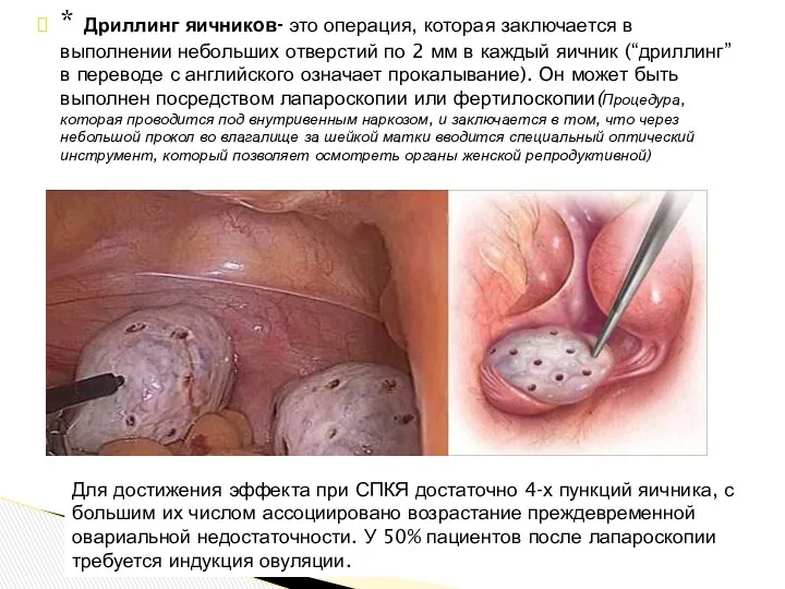 * Дриллинг яичников- это операция, которая заключается в выполнении небольших