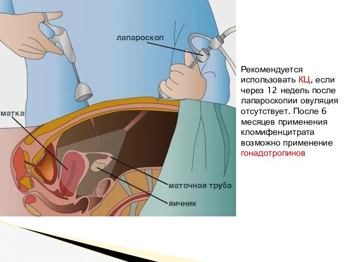 Рекомендуется использовать КЦ, если через 12 недель после лапароскопии овуляция