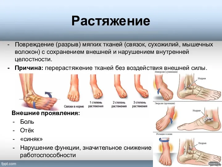 Растяжение Повреждение (разрыв) мягких тканей (связок, сухожилий, мышечных волокон) с сохранением внешней и