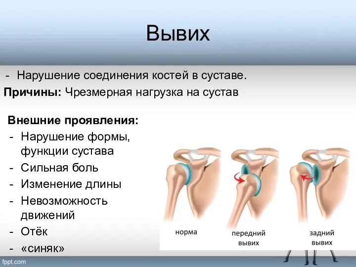 Вывих Нарушение соединения костей в суставе. Причины: Чрезмерная нагрузка на