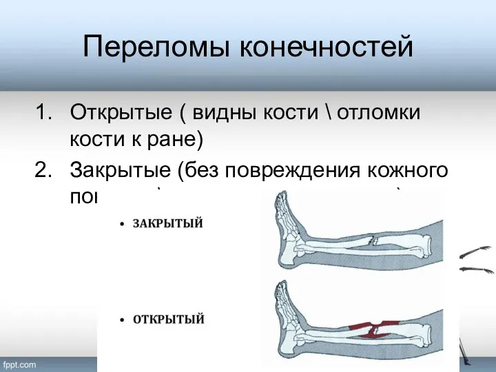 Переломы конечностей Открытые ( видны кости \ отломки кости к ране) Закрытые (без