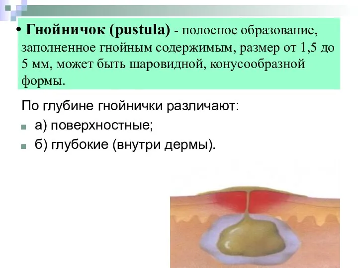 Гнойничок (pustula) - полосное образование, заполненное гнойным содержимым, размер от 1,5 до 5