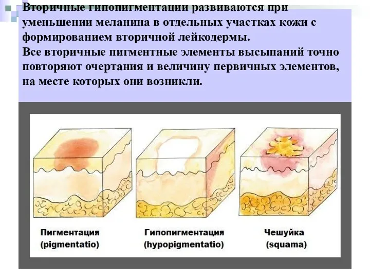 Вторичные гипопигментации развиваются при уменьшении меланина в отдельных участках кожи с формированием вторичной