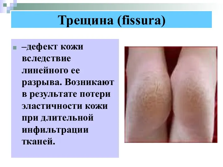 Трещина (fissura) –дефект кожи вследствие линейного ее разрыва. Возникают в результате потери эластичности