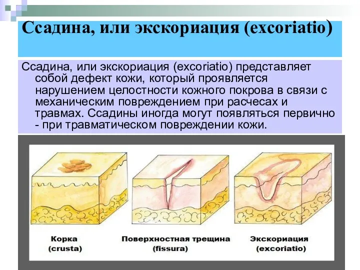 Ссадина, или экскориация (excoriatio) Ссадина, или экскориация (excoriatio) представляет собой дефект кожи, который