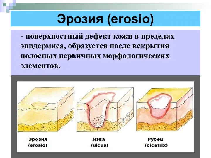 Эрозия (erosio) - поверхностный дефект кожи в пределах эпидермиса, образуется после вскрытия полосных первичных морфологических элементов.
