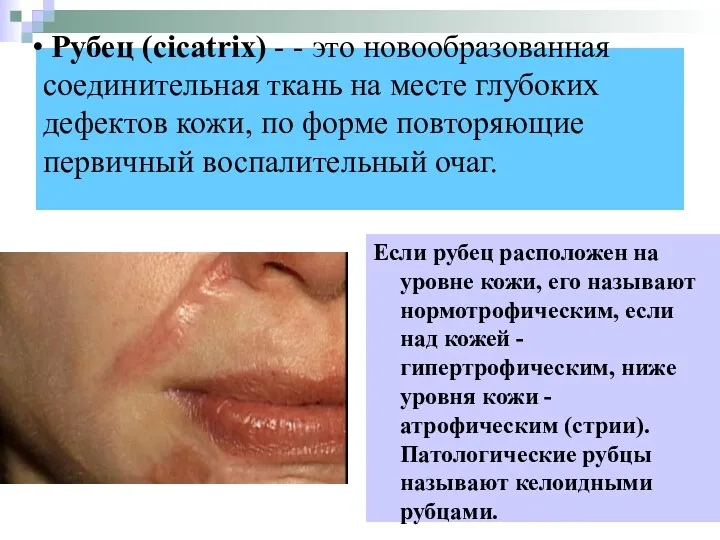 Рубец (cicatrix) - - это новообразованная соединительная ткань на месте глубоких дефектов кожи,