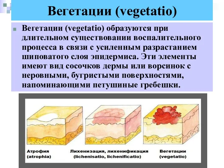 Вегетации (vegetatio) Вегетации (vegetatio) образуются при длительном существовании воспалительного процесса в связи с