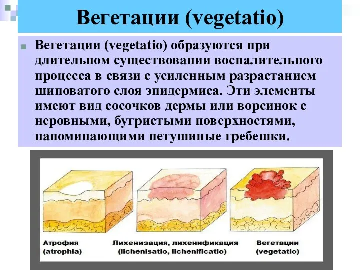 Вегетации (vegetatio) Вегетации (vegetatio) образуются при длительном существовании воспалительного процесса