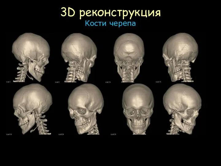 3D реконструкция Кости черепа