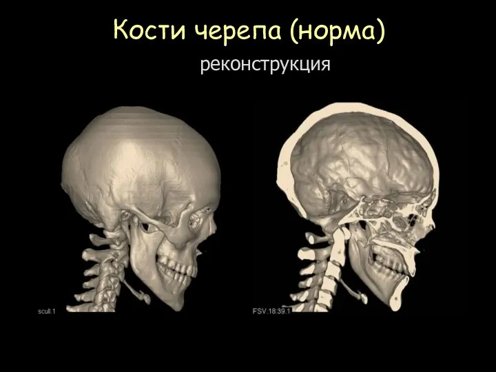 Кости черепа (норма) 3D реконструкция
