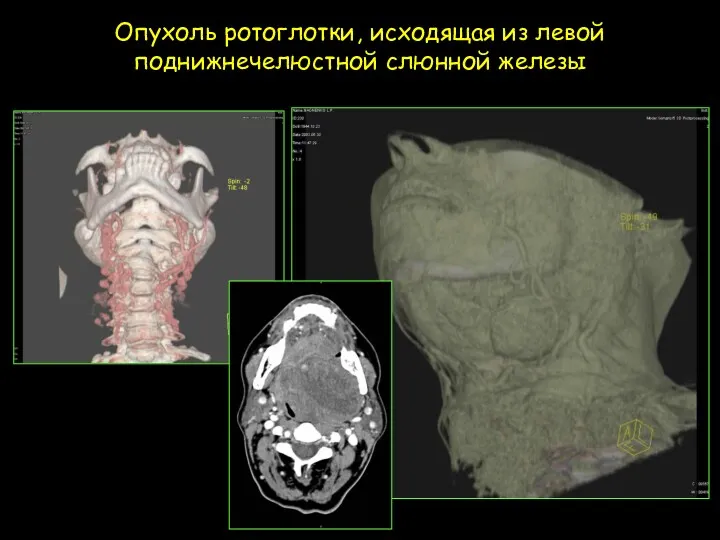 Опухоль ротоглотки, исходящая из левой поднижнечелюстной слюнной железы