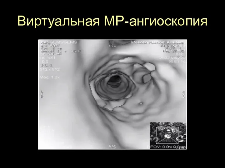 Виртуальная МР-ангиоскопия Нажмите на изображение для запуска видео