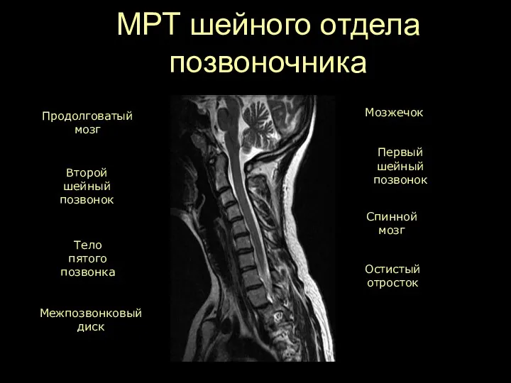 МРТ шейного отдела позвоночника Продолговатый мозг Спинной мозг Второй шейный позвонок Межпозвонковый диск