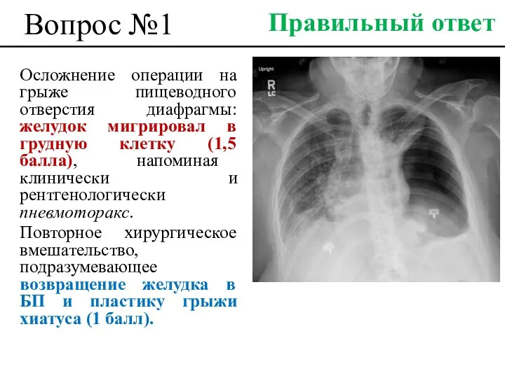 Вопрос №1 Осложнение операции на грыже пищеводного отверстия диафрагмы: желудок