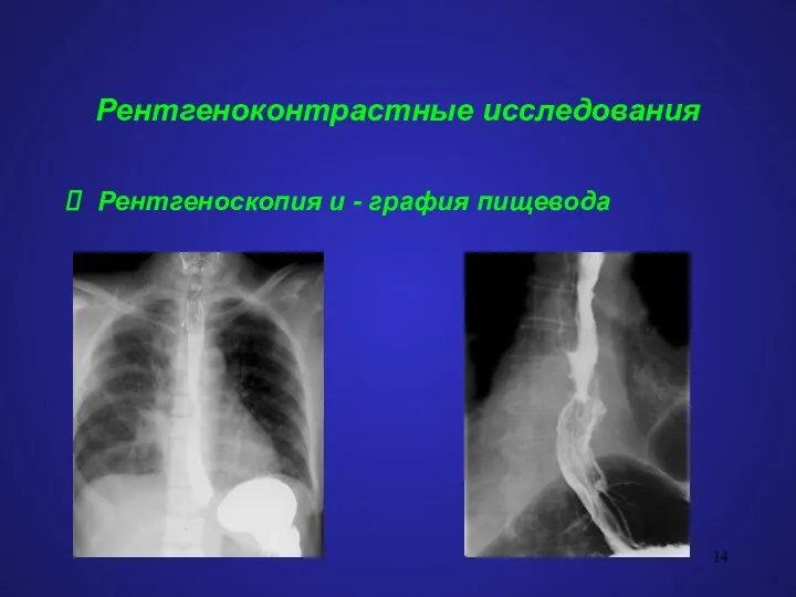 Рентгеноконтрастные исследования Рентгеноскопия и - графия пищевода